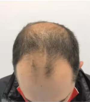 Tratamiento Capilar resultados