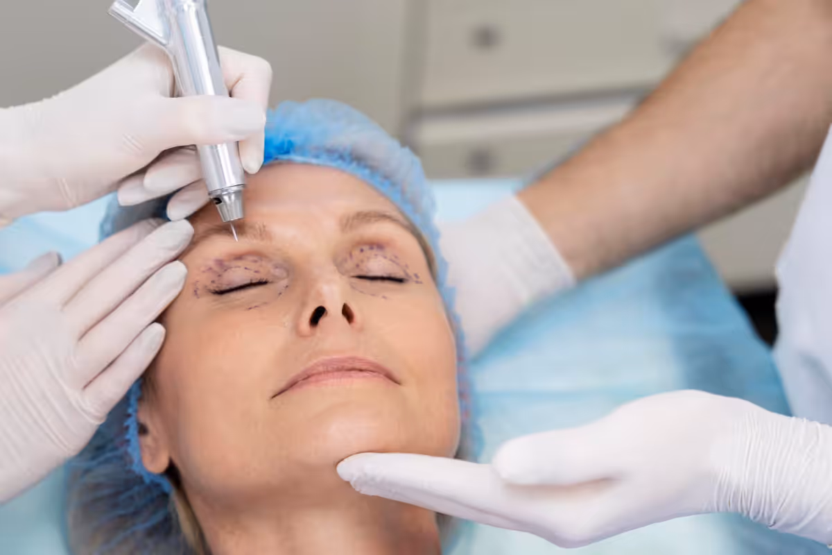 Blefaroplastia: ¿Cuándo Elegir la Cirugía y Cuándo Optar por Plasma Pen?