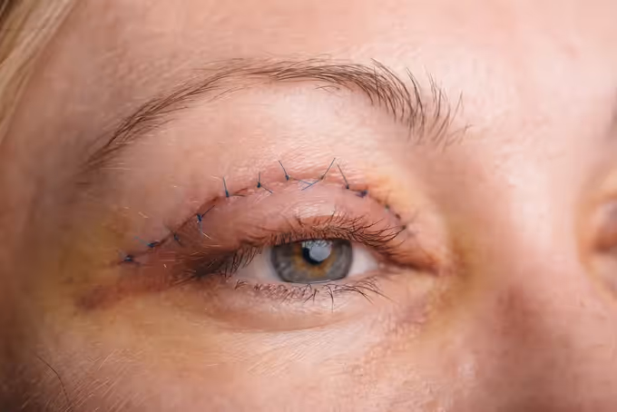 Blefaroplastia: ¿Qué es, cómo se hace y cuáles son sus beneficios?