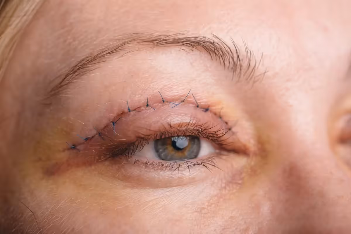 Blefaroplastia: ¿Qué es, cómo se hace y cuáles son sus beneficios?