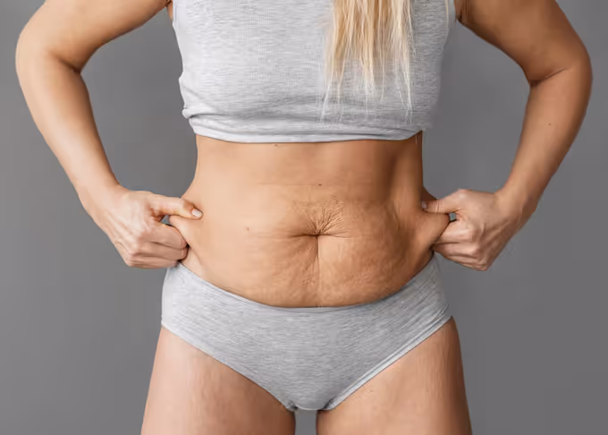 Endoláser Anticelulitis: Resultados en una Sola Sesión vs. Mesoterapia Clásica