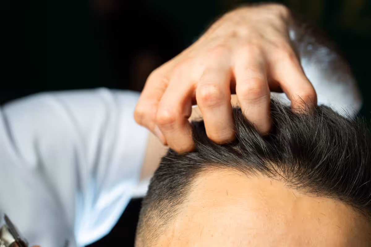 Exosomas vs. PRP Capilar: ¿Cuál Conviene según tu Grado de Alopecia?